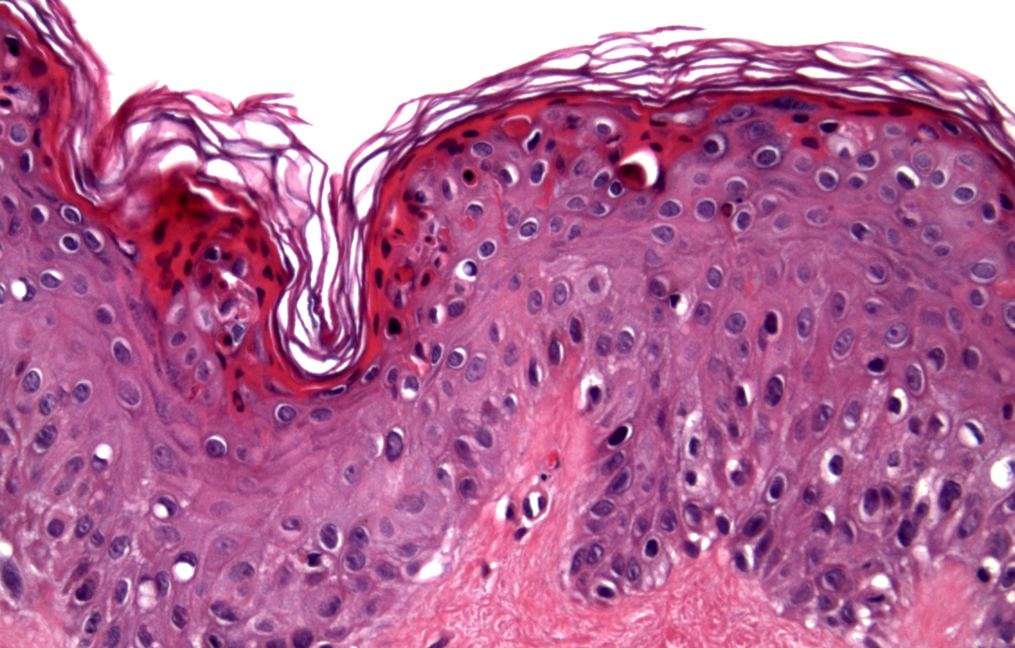 Dermatopathology | definition of dermatopathology by ...